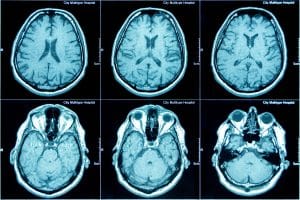 MRI scan of the brain, medical examination of the brain