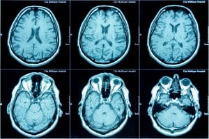 MRI scan of the brain, medical examination of the brain