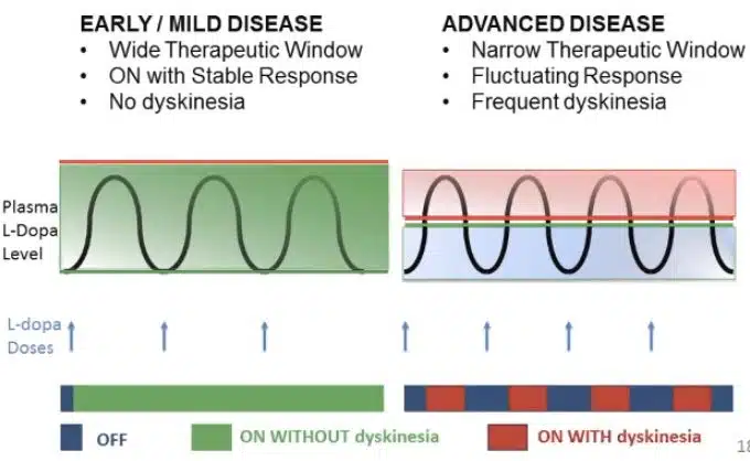 two charts showing the difference in dyskinesia in early disease vs advanced disease