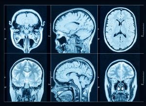 Closeup of a CT scan with brain