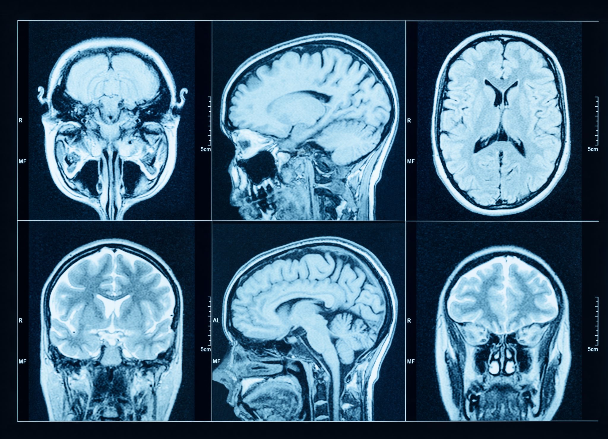 Closeup of a CT scan with brain